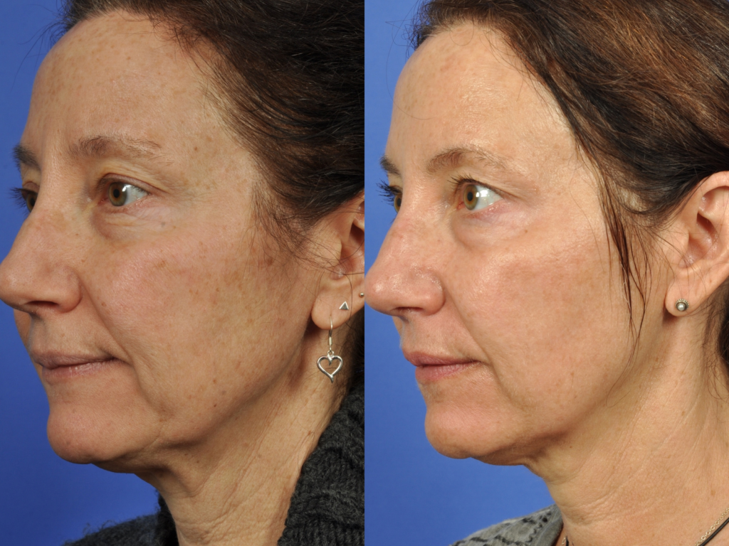microneedling-48-yo-woman-side-1024x768