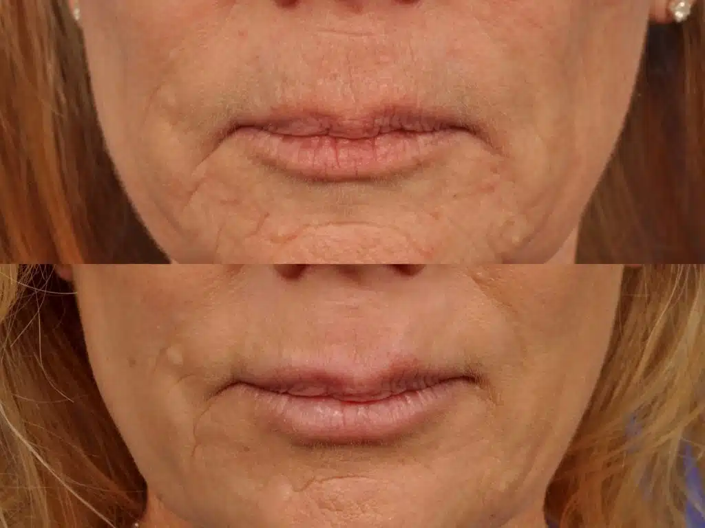 microneedling-50-yo-woman-1024x768