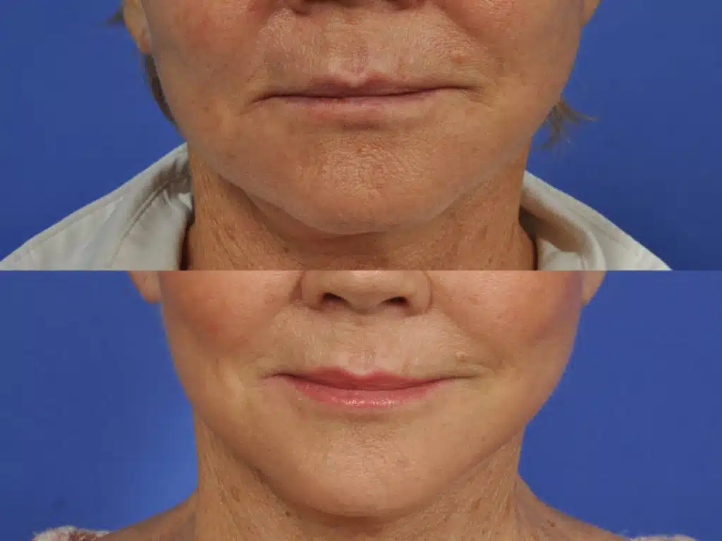 microneedling-71-yo-woman-1024x768