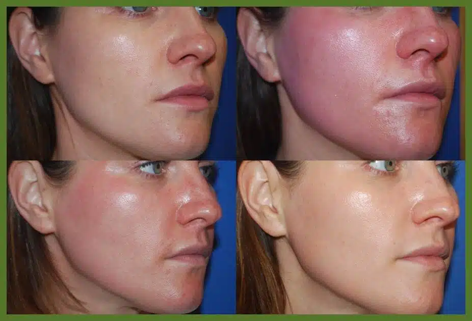 microneedling-for-web