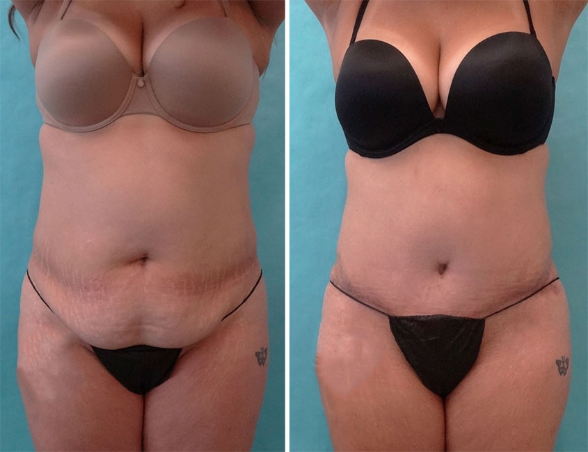 tummy-tuck-22