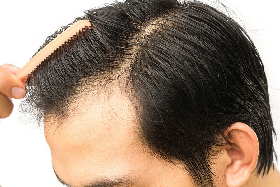 what-makes-you-a-good-candidate-for-a-hair-transplant-2