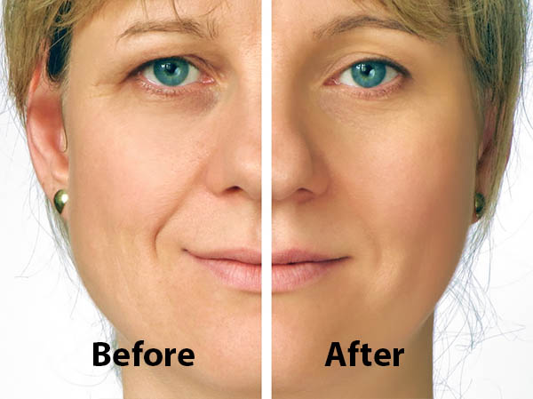 correction-of-wrinkles-on-half-face-2