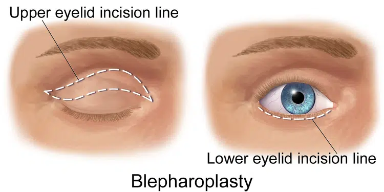 blepharoplasty-eyelift-width-750-2