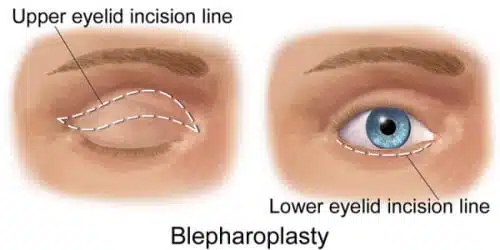 blepharoplasty-eyelift-width-77777