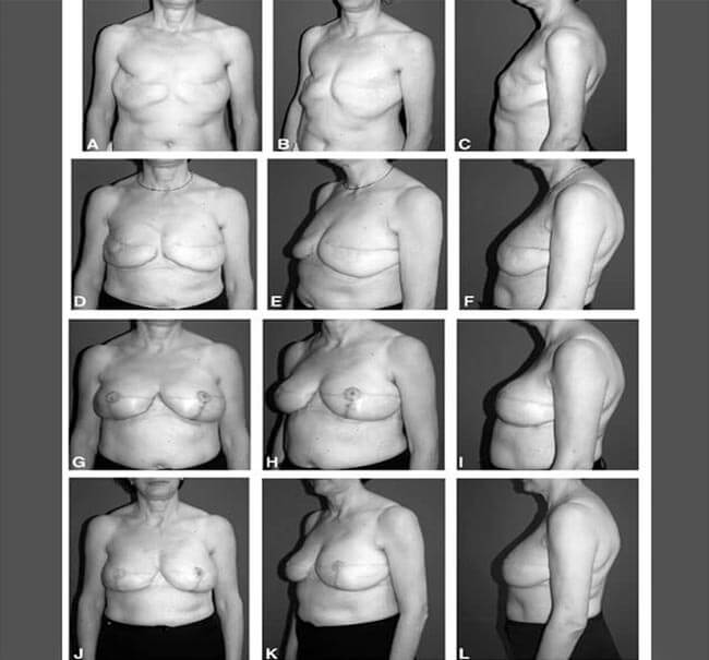 breast-reconstruction-with-fat-grafting-jpg2_55