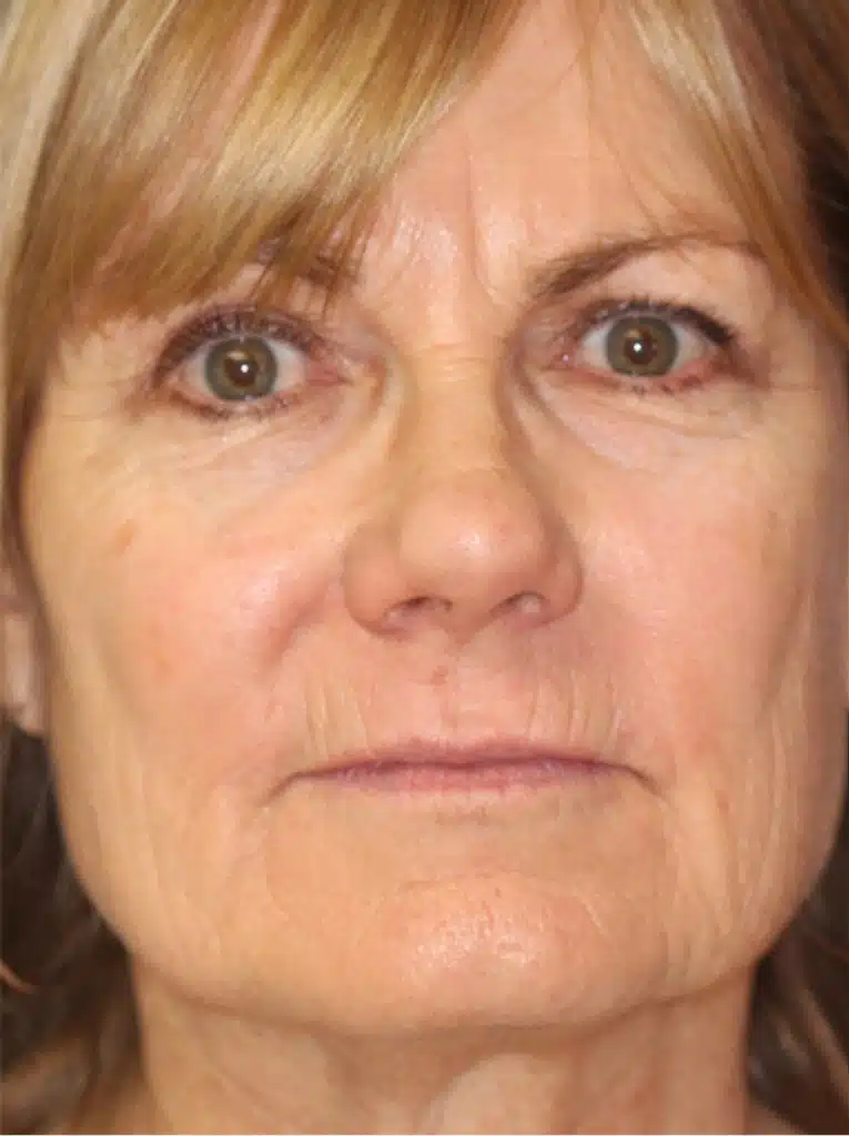 Chemical peeling 222