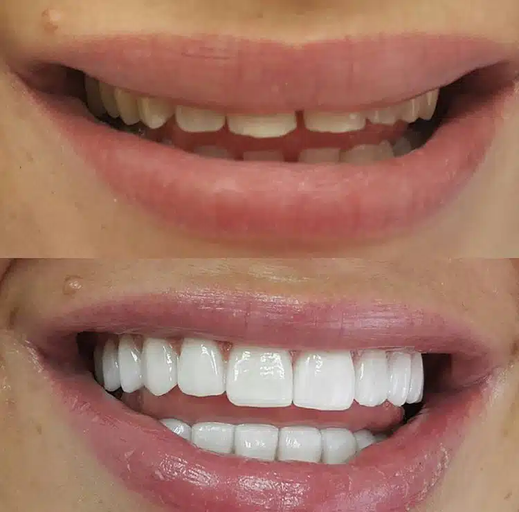 composite-veneer