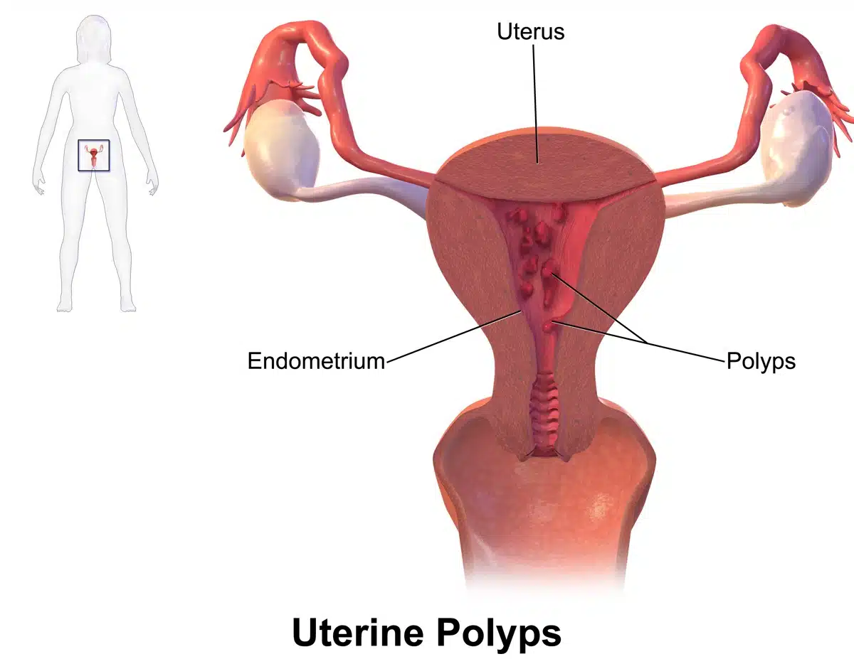 hysteroscopy-and-polypectomy4