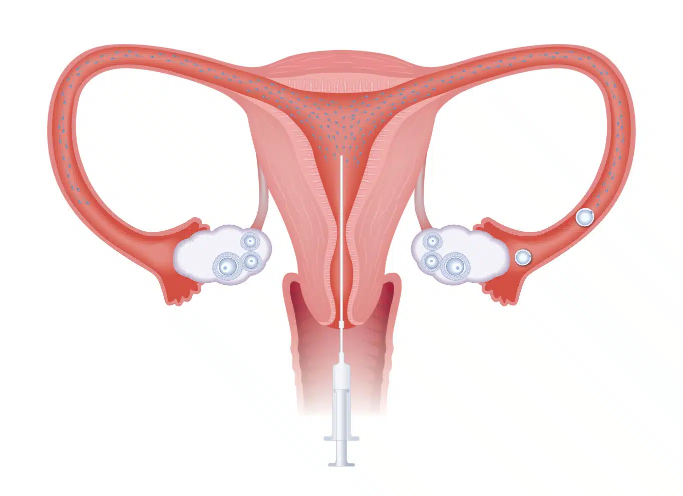 iui-intrauterine-insemination-2