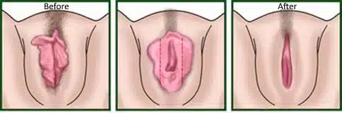 labiaplasty-procedure