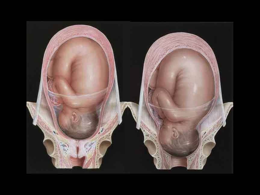 labour-and-effacement-of-the-cervix