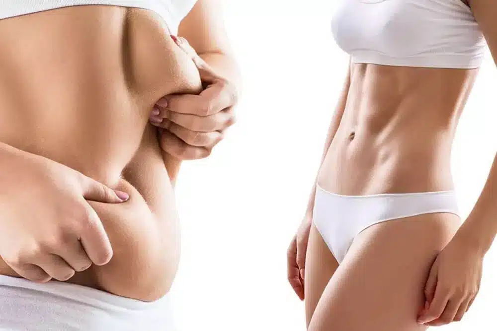 liposuction-on-arms-and-back22