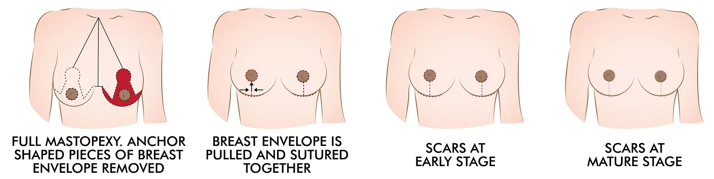 mastopexy2