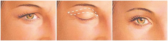procedure