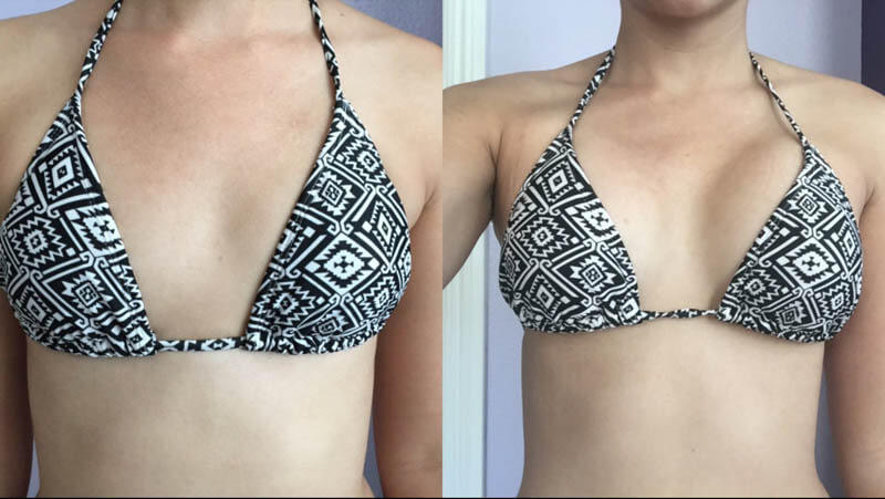 breast-augmentation-2