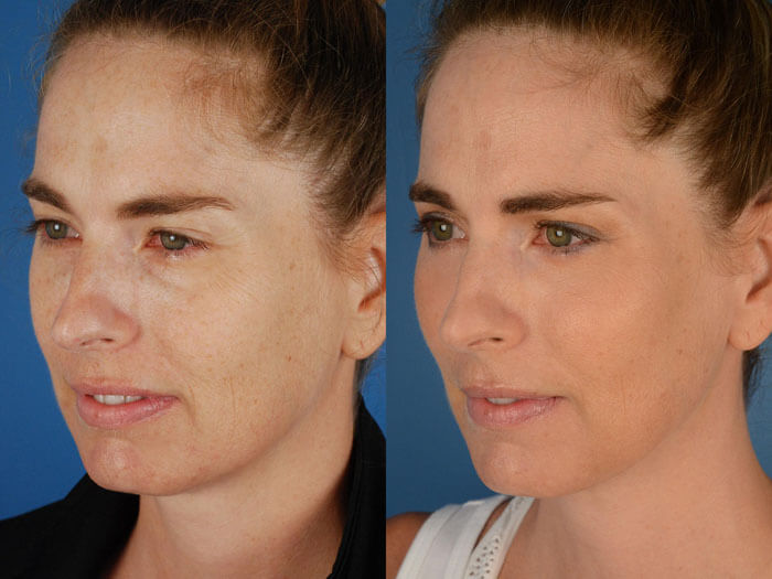 fat-injection-before-and-after-2-2