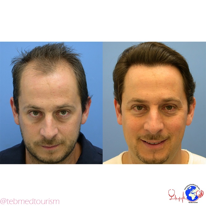 hair-transplant-ba