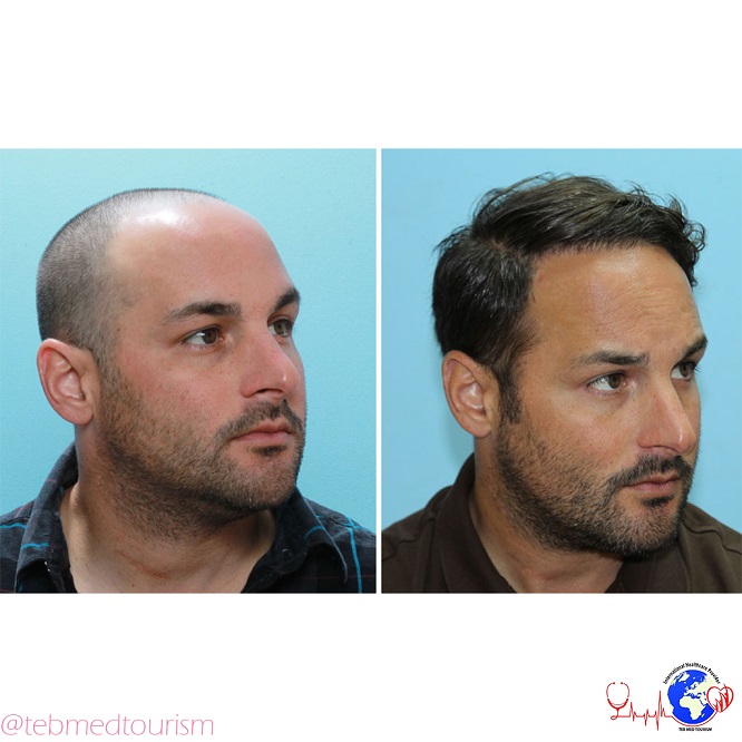 hair-transplant-ba2
