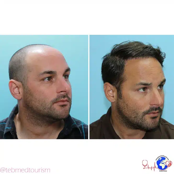 hair-transplant-ba2
