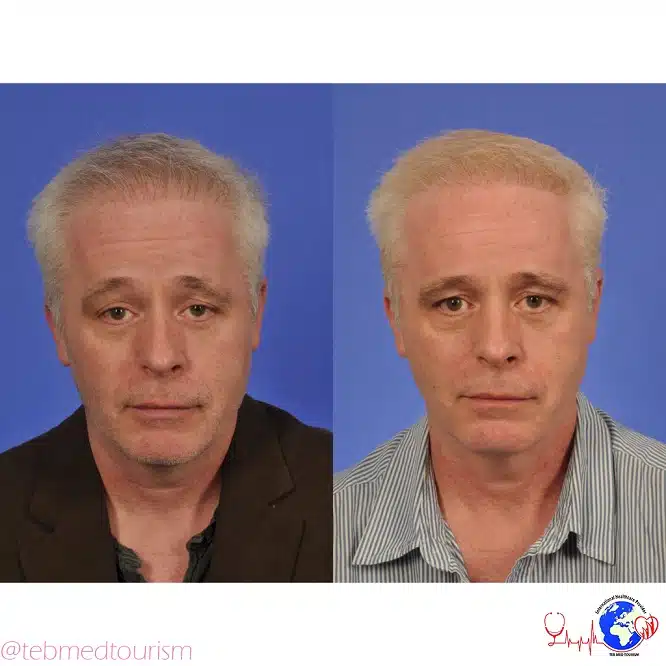 hair-transplant-ba3