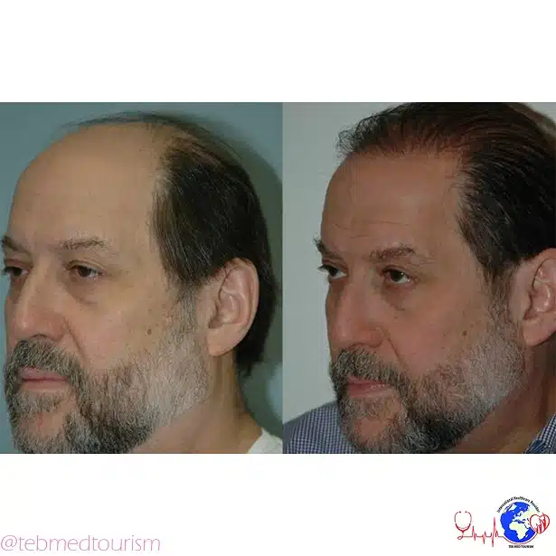 hair-transplant-ba4