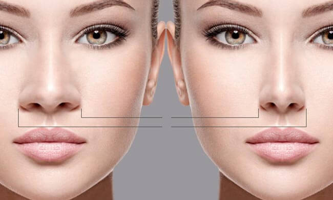 rhinoplasty-in-iran-1