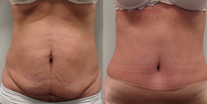 tummy-tuck-2