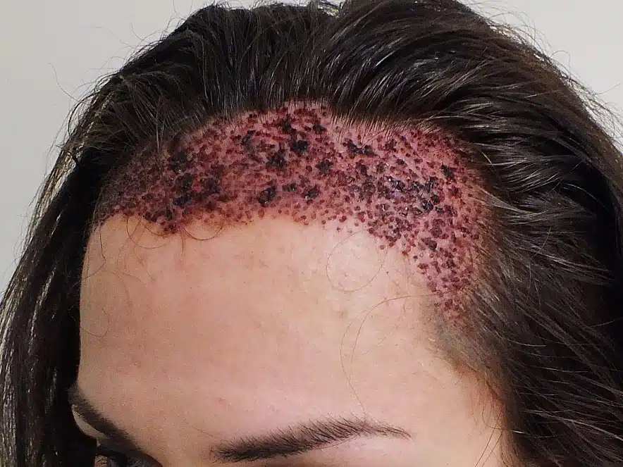 female-hair-transplant-after-surgery-side-view-418921423