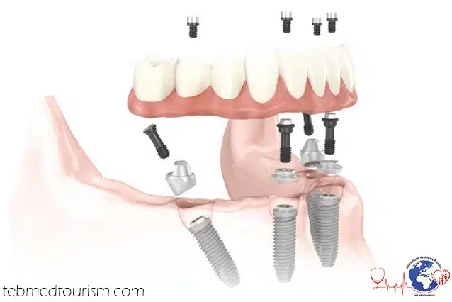 dental-implants32