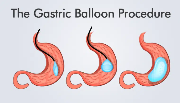 the-gastric-balloon-procedures-760x434
