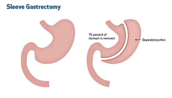 wm_sleevegastrectomy_550x314