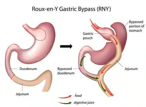 bariatric