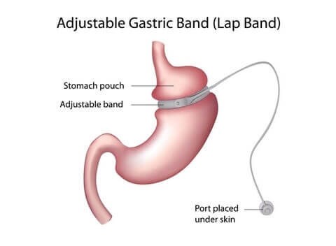 lap-band