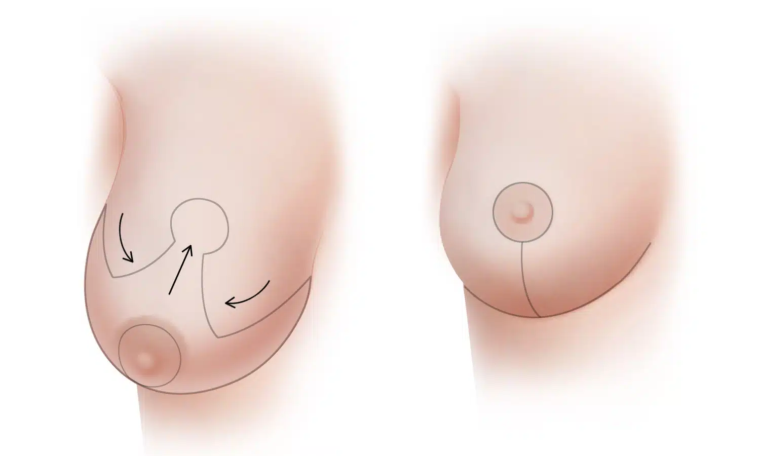 breast_reduction_type_a_2018