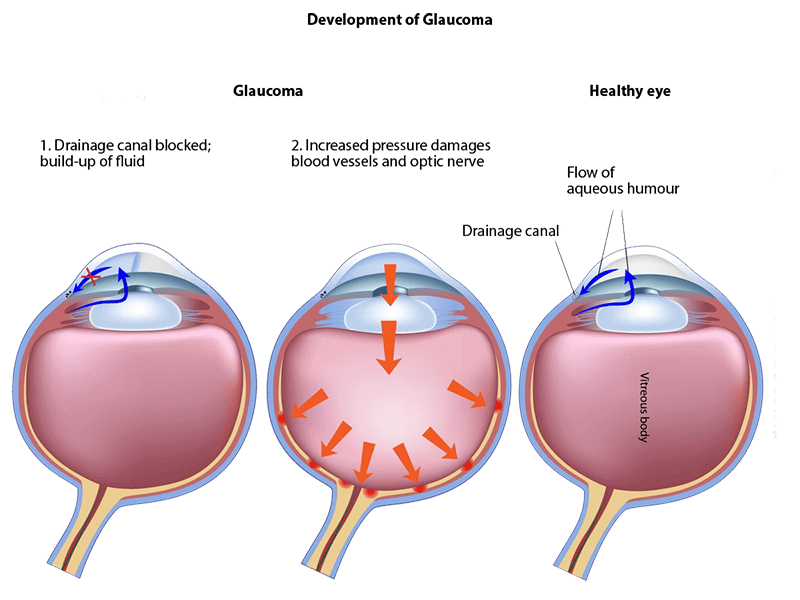 glaucoma-chart
