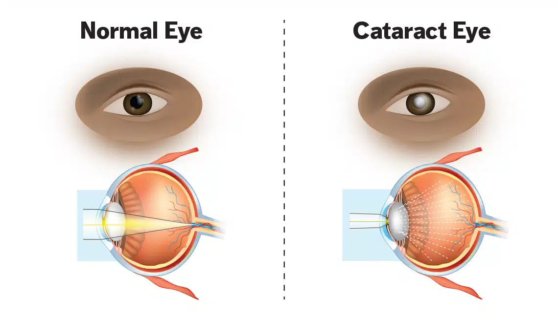1140-infographic-normal-eye-versus-cataract-eye-imgcache-rev8f6f1c256de898f611fa165533b345b3-1
