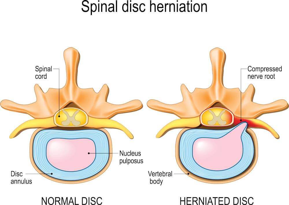 disc-herniation-treatment-8846
