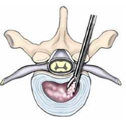 discectomy-250x250