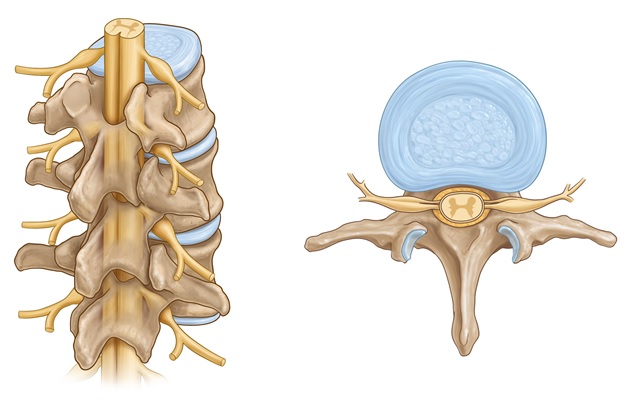 discectomy