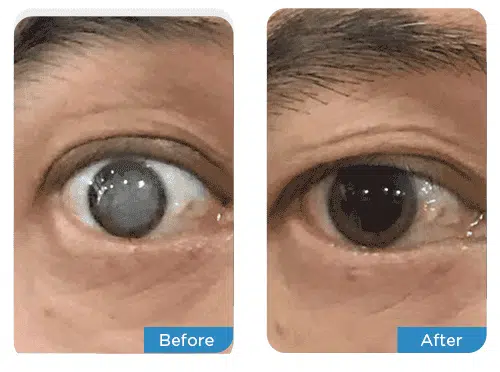 ophthalmologists-cataract-2-before-after-medical-tourism