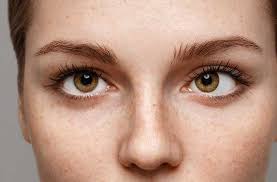 strabismus-2