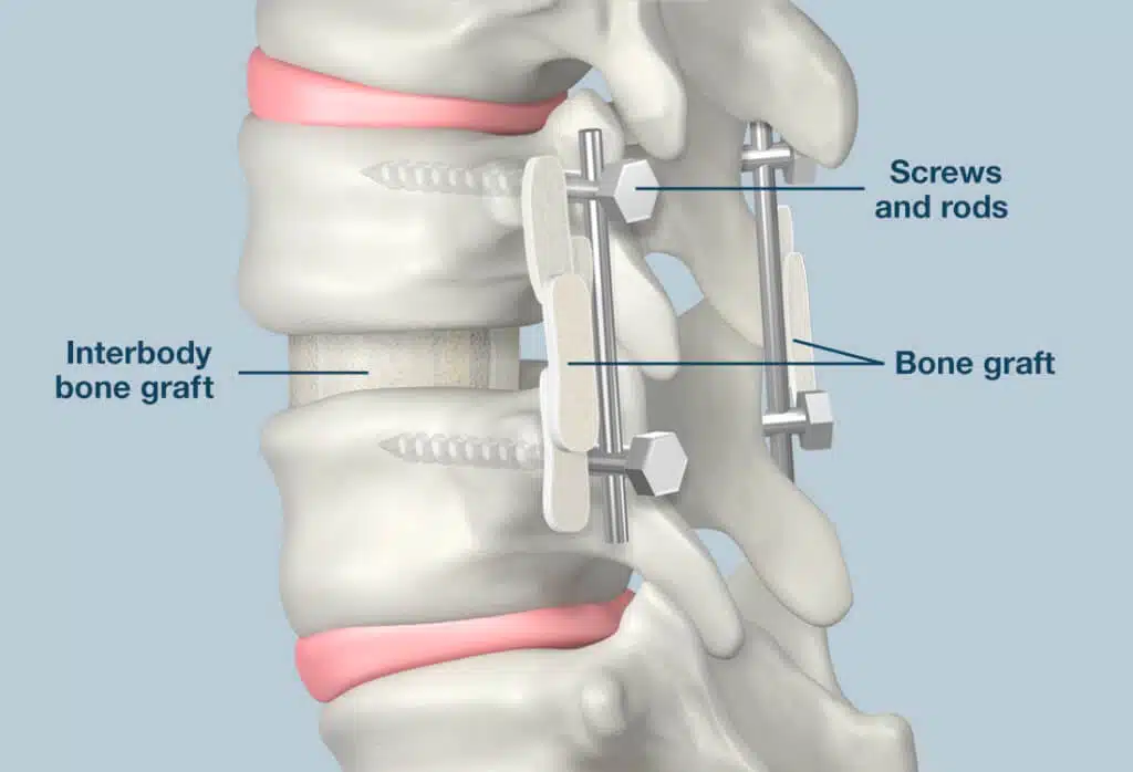 Posterior spinal fusion2424