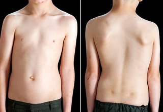 s_1017_scoliosis_c0259633_c0259632-width-320