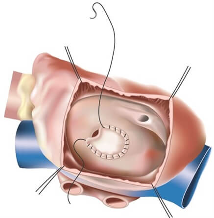 atrial001
