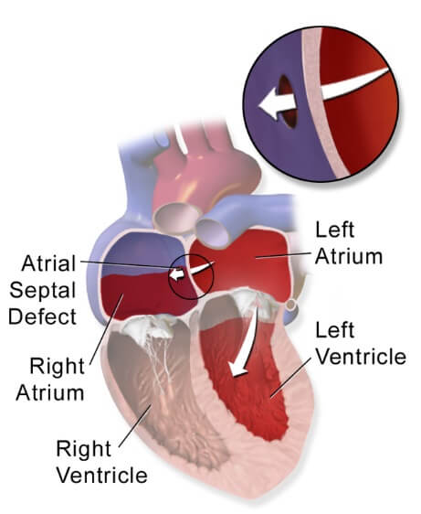 atrial002