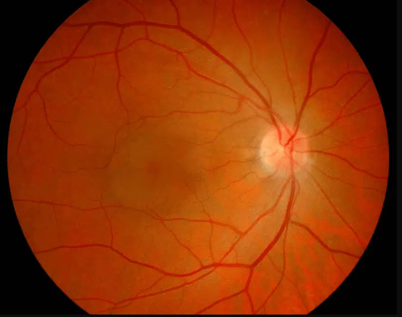 central-serous-retinopathy