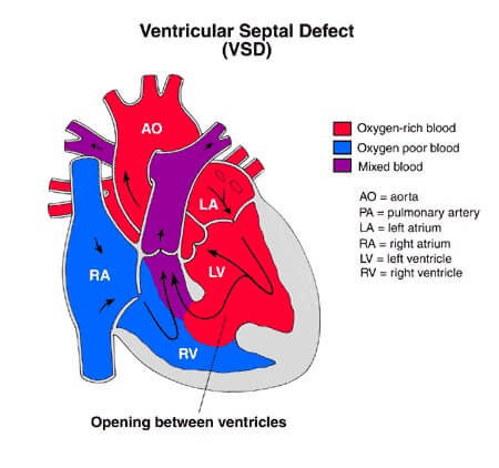 chw_vsd2