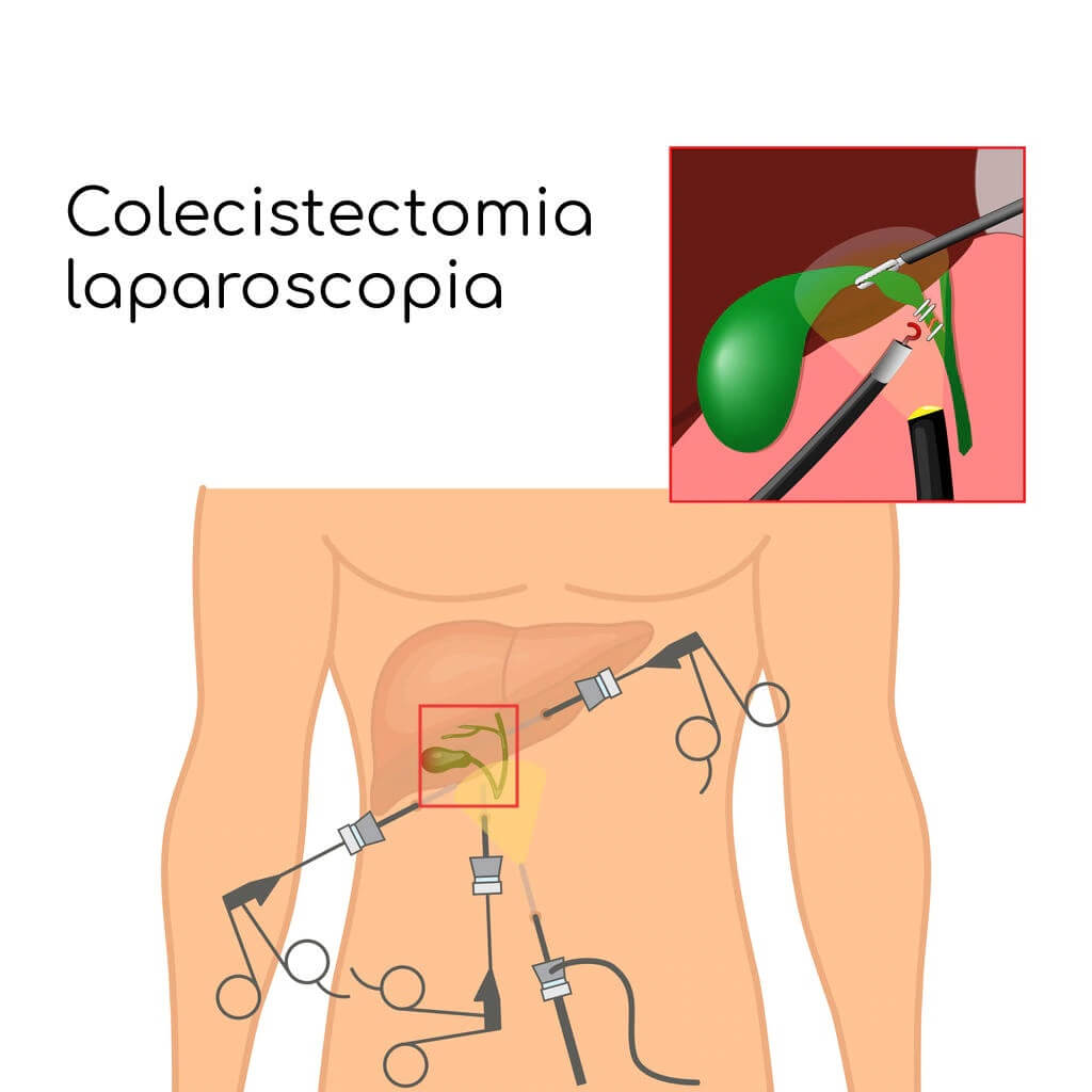 colecistectomia-laparoscopica2