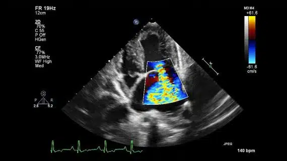 echocardiogram-color-570x321